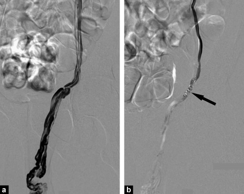 Varicocel embolization procedure diagram 1